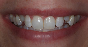 Before
